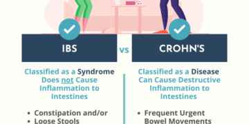 Causes, Symptoms, and Treatment of Crohn’s Disease